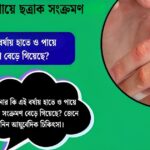 Fungal infections have increased.(ছত্রাক সংক্রমণ বেড়ে গিয়েছে)