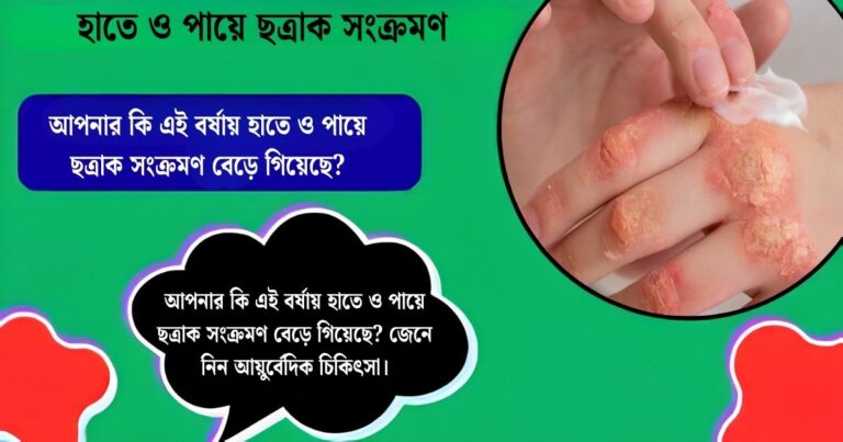 Fungal infections have increased.(ছত্রাক সংক্রমণ বেড়ে গিয়েছে)